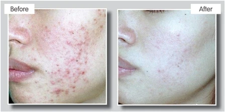 acne / diepte reiniging
